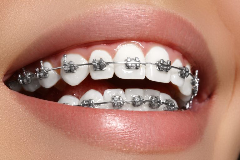 Orthodontic Treatments