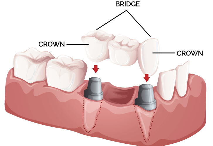 dental-bridge-crowns