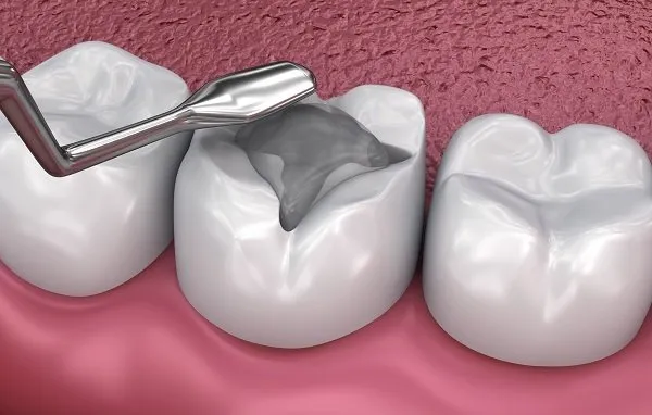 dental-filling