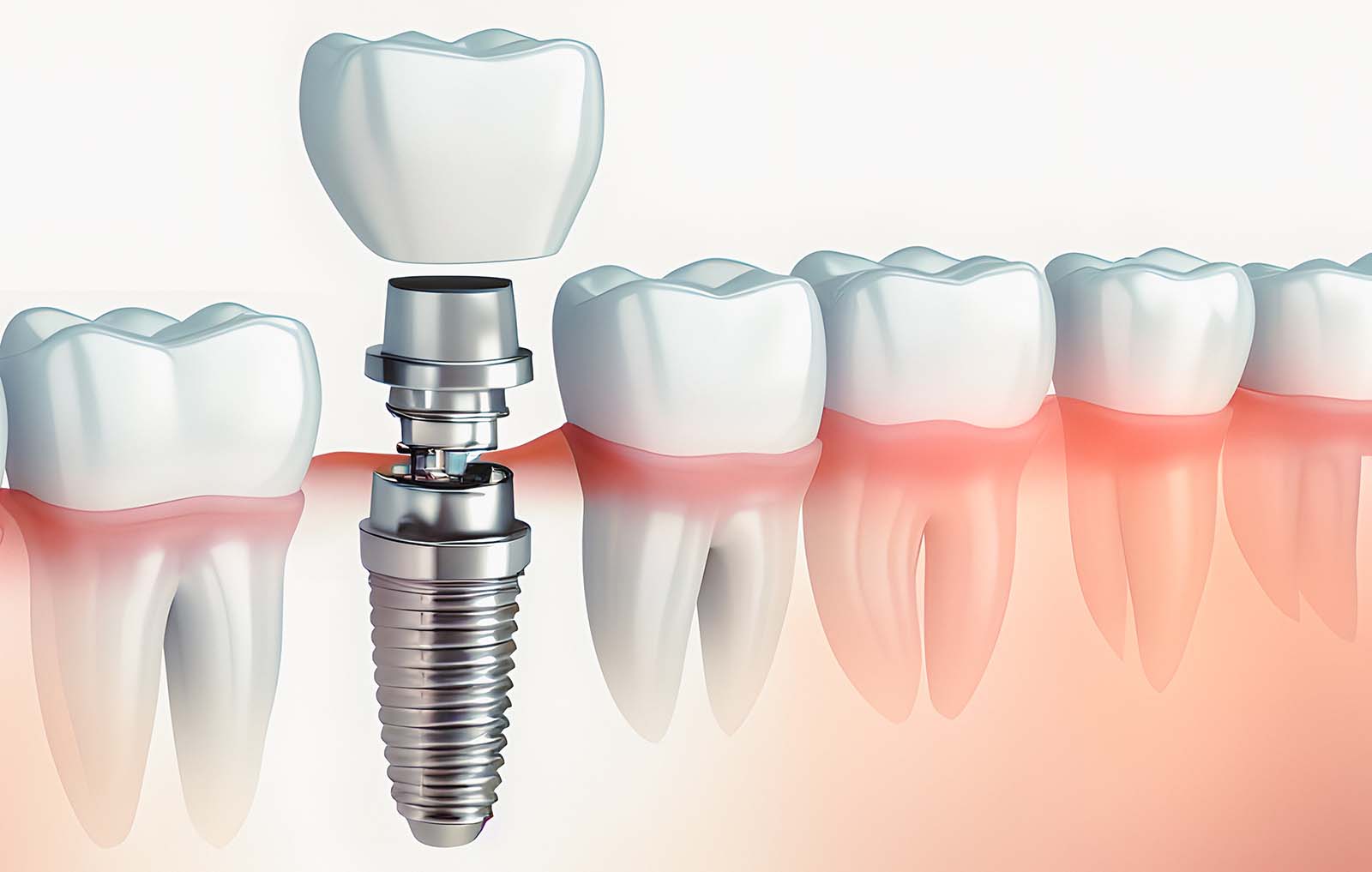 dental-implants-picture